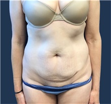 Breast Reduction Before and After Photos by Brian Pinsky, MD, FACS;  Huntington Station, NY - Case 35471