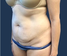 Tummy Tuck Before Photo by Brian Pinsky, MD, FACS; Huntington Station, NY - Case 41415