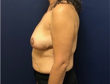 Breast Reduction After Photo by Brian Pinsky, MD, FACS; Huntington Station, NY - Case 42513