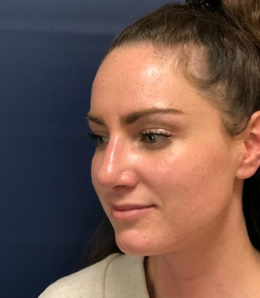 Rhinoplasty Before and After Photos by Brian Pinsky, MD, FACS
