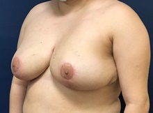 Breast Reduction After Photo by Brian Pinsky, MD, FACS; Huntington Station, NY - Case 43298
