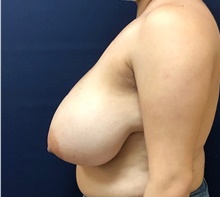 Breast Reduction Before Photo by Brian Pinsky, MD, FACS; Huntington Station, NY - Case 43298