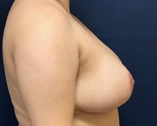 Breast Reduction After Photo by Brian Pinsky, MD, FACS; Huntington Station, NY - Case 43298