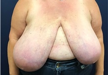 Breast Reduction Before Photo by Brian Pinsky, MD, FACS; Babylon, NY - Case 43300