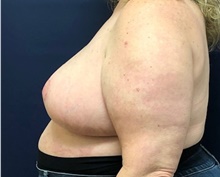 Breast Reduction After Photo by Brian Pinsky, MD, FACS; Huntington Station, NY - Case 43300