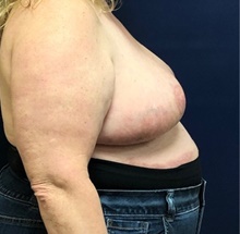 Breast Reduction After Photo by Brian Pinsky, MD, FACS; Huntington Station, NY - Case 43300