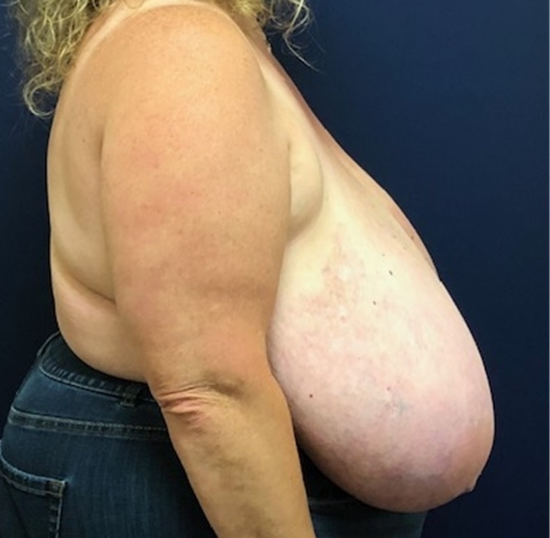 Breast Reduction Before and After Photos by Brian Pinsky, MD, FACS