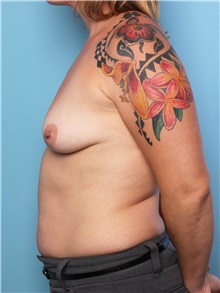 Breast Augmentation Before Photo by Mark Gaon, MD; Newport Beach, CA - Case 29184