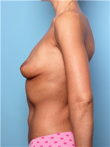 Breast Augmentation Before Photo by Mark Gaon, MD; Newport Beach, CA - Case 29185