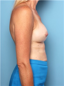 Breast Augmentation After Photo by Mark Gaon, MD; Newport Beach, CA - Case 29187