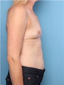 Breast Augmentation Before Photo by Mark Gaon, MD; Newport Beach, CA - Case 29187