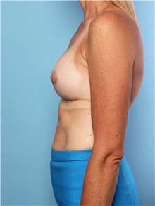 Breast Augmentation After Photo by Mark Gaon, MD; Newport Beach, CA - Case 29187