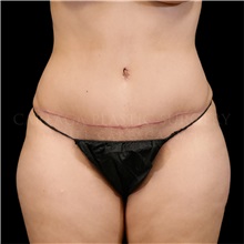 Buttock Lift with Augmentation Before Photo by Daniel Careaga, MD; Coral Gables, FL - Case 32805