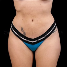 Buttock Lift with Augmentation After Photo by Daniel Careaga, MD; Coral Gables, FL - Case 32822