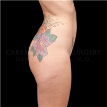 Buttock Lift with Augmentation Before Photo by Daniel Careaga, MD; Coral Gables, FL - Case 32822