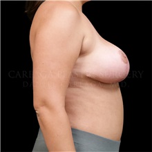 Breast Reduction After Photo by Daniel Careaga, MD; Coral Gables, FL - Case 33545