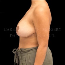 Breast Reduction After Photo by Daniel Careaga, MD; Coral Gables, FL - Case 33559
