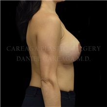 Breast Lift After Photo by Daniel Careaga, MD; Coral Gables, FL - Case 35515