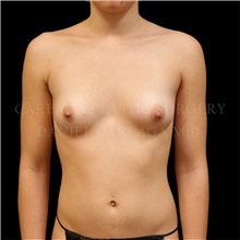 Breast Augmentation Before Photo by Daniel Careaga, MD; Coral Gables, FL - Case 35522