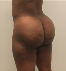 Buttock Lift with Augmentation After Photo by Ravi Somayazula, DO; Houston, TX - Case 36630