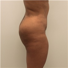 Buttock Lift with Augmentation After Photo by Ravi Somayazula, DO; Houston, TX - Case 41264