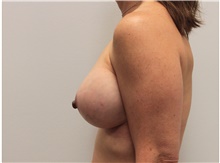 Breast Implant Revision After Photo by Ravi Somayazula, DO; Houston, TX - Case 41265