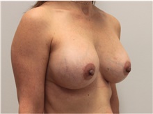 Breast Implant Revision After Photo by Ravi Somayazula, DO; Houston, TX - Case 41265