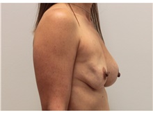 Breast Implant Revision Before Photo by Ravi Somayazula, DO; Houston, TX - Case 41265