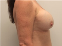 Breast Implant Revision Before Photo by Ravi Somayazula, DO; Houston, TX - Case 41266