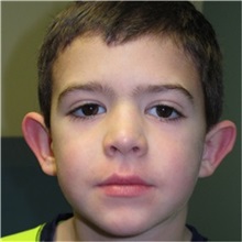 Ear Surgery Before Photo by Richard Kutz, MD, MPH, FACS; South Portland, ME - Case 37301