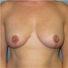Breast Reduction After Photo by Richard Kutz, MD, MPH; South Portland, ME - Case 37303