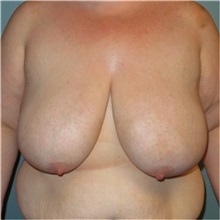Breast Reduction Before Photo by Richard Kutz, MD, MPH, FACS; South Portland, ME - Case 37304