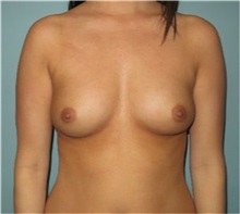 Breast Augmentation Before Photo by Richard Kutz, MD, MPH; South Portland, ME - Case 37307