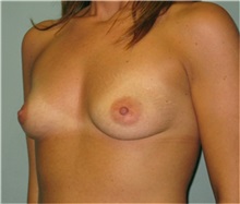 Breast Augmentation Before Photo by Richard Kutz, MD, MPH; South Portland, ME - Case 37308