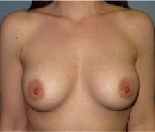 Breast Augmentation After Photo by Richard Kutz, MD, MPH; South Portland, ME - Case 37308