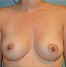Breast Augmentation After Photo by Richard Kutz, MD, MPH, FACS; South Portland, ME - Case 37309