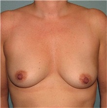 Breast Augmentation Before Photo by Richard Kutz, MD, MPH; South Portland, ME - Case 37309