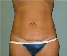 Tummy Tuck Before Photo by Richard Kutz, MD, MPH; South Portland, ME - Case 37311