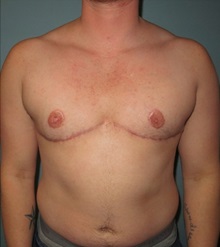Gender Affirmation Surgery After Photo by Richard Kutz, MD, MPH, FACS; South Portland, ME - Case 37312