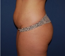 Buttock Implants Before Photo by Richard Reish, MD, FACS; New York, NY - Case 30551