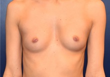 Breast Augmentation Before Photo by Richard Reish, MD, FACS; New York, NY - Case 30558