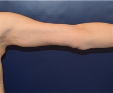 Arm Lift After Photo by Richard Reish, MD, FACS; New York, NY - Case 30561
