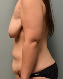 Tummy Tuck Before Photo by Richard Reish, MD, FACS; New York, NY - Case 30563