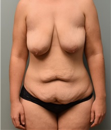 Tummy Tuck Before Photo by Richard Reish, MD, FACS; New York, NY - Case 30563