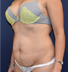 Tummy Tuck Before Photo by Richard Reish, MD, FACS; New York, NY - Case 30566