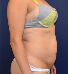 Tummy Tuck Before Photo by Richard Reish, MD, FACS; New York, NY - Case 30566