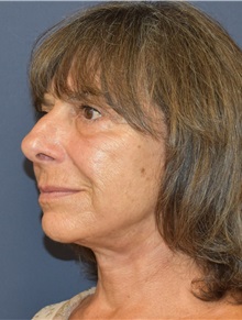 Facelift After Photo by Richard Reish, MD, FACS; New York, NY - Case 30567