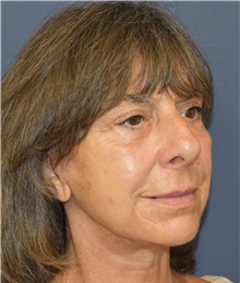 Facelift After Photo by Richard Reish, MD, FACS; New York, NY - Case 30567