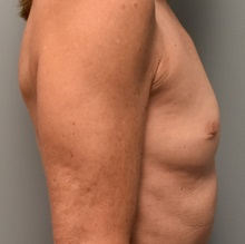 Breast Augmentation Before Photo by Richard Reish, MD, FACS; New York, NY - Case 30575