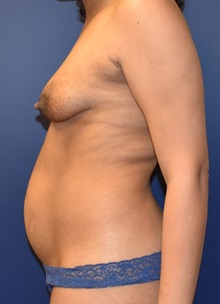 Tummy Tuck Before Photo by Richard Reish, MD, FACS; New York, NY - Case 30778
